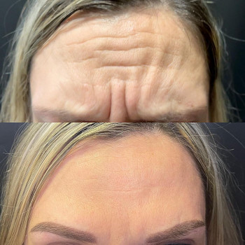 Ботулінотерапія міжбрів'я