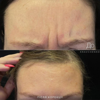 Ботулінотерапія міжбрів'я