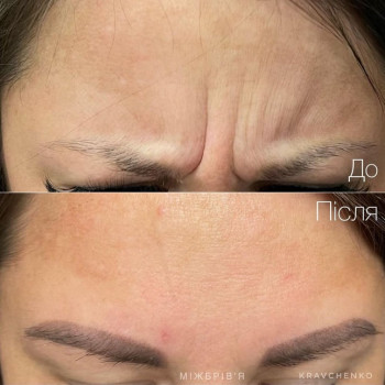 Ботулінотерапія міжбрів'я