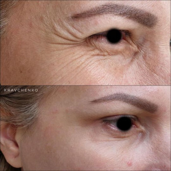 Ботокс навколо очей