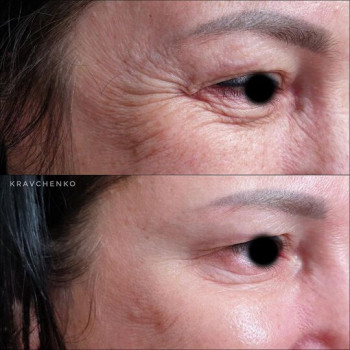 Ботокс навколо очей