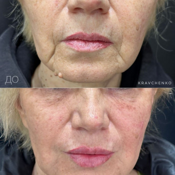 Radiesse + губи + носогубні