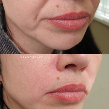 Заповнення носогубних складок