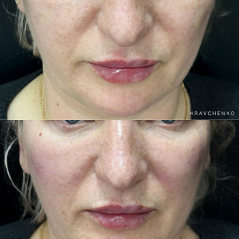 Radiesse під очі