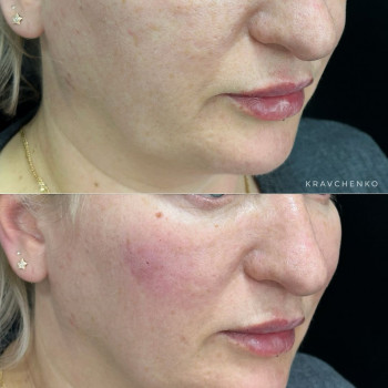 Radiesse під очі