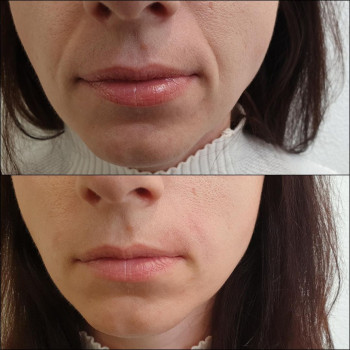 Заповнення носогубних складок