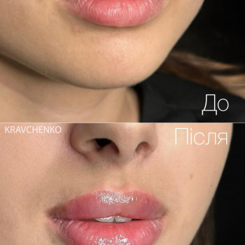 Збільшення губ / До та після загоєння