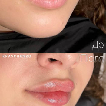 Збільшення губ / До та після загоєння