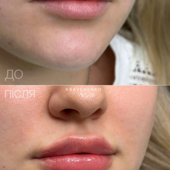 Збільшення губ / До та після загоєння