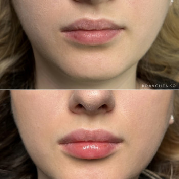 Збільшення губ
До та після загоєння