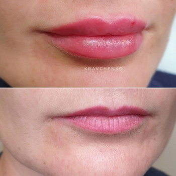 Збільшення губ