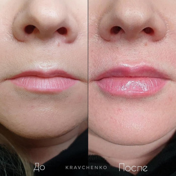 Збільшення губ