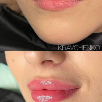 Збільшення губ