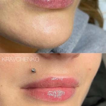 Збільшення губ