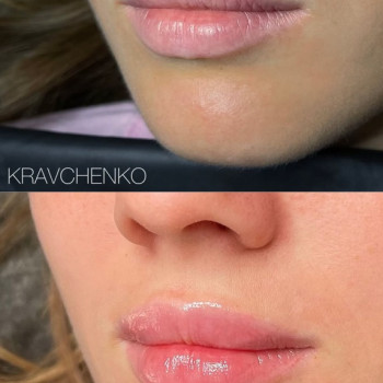 Збільшення губ