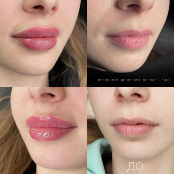 Збільшення губ