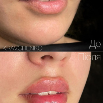 Збільшення губ