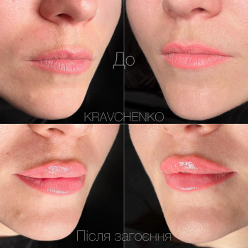 Збільшення губ