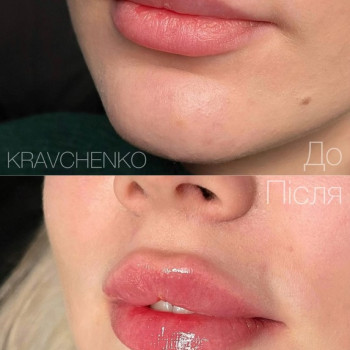 Збільшення губ