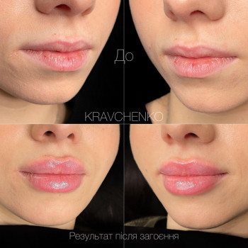 Збільшення губ