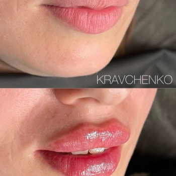 Збільшення губ