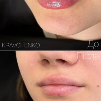 Збільшення губ