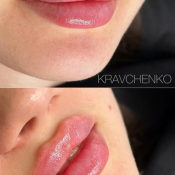 Збільшення губ