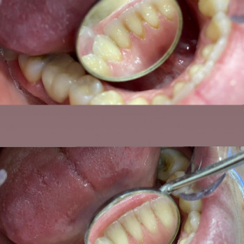 Чистка зубів