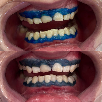 Відбілювання зубів