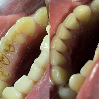 Чистка зубів