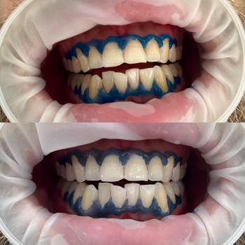 Відбілювання