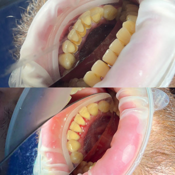 Чистка зубів