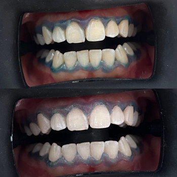 Відбілювання