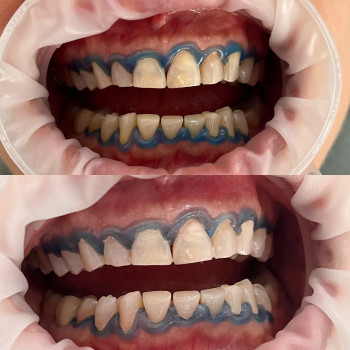 Відбілювання