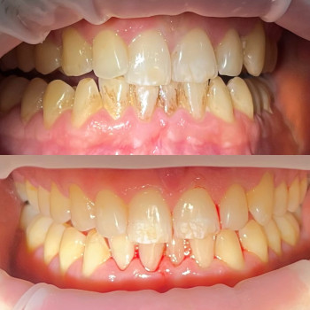 Чистка зубів