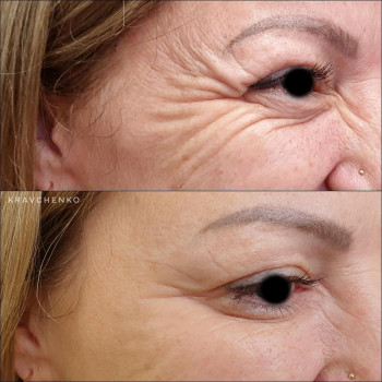 Лікування гіпергідрозу / Пахви, долоні, ступні
                    Врач-косметолог Филипп Киев