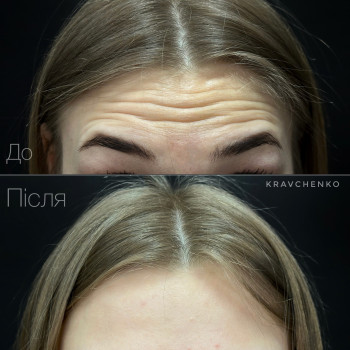 Лікування гіпергідрозу / Пахви, долоні, ступні
                    Врач-косметолог Филипп Киев