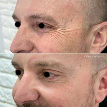 Лікування гіпергідрозу / Пахви, долоні, ступні
                    Врач-косметолог Филипп Киев