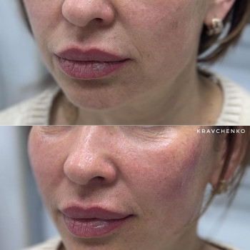 Біоревіталізація
                    Лікар-косметолог Филипп Київ