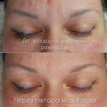 Удаление ремувером татуажа и тату
                    Мастер перманентного макияжа Наталя Харьков