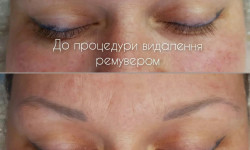 Видалення татуажу та тату ремувером Мастер перманентного макияжа Наталя Харьков