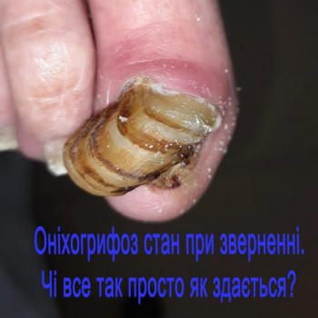 Оніхогрифоз