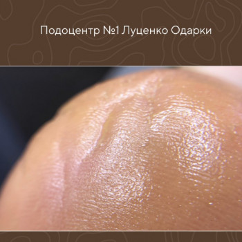 подологія, чищення п'яти, лікування стопи, мозоль на стопі