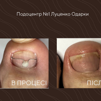 врослий ніготь
