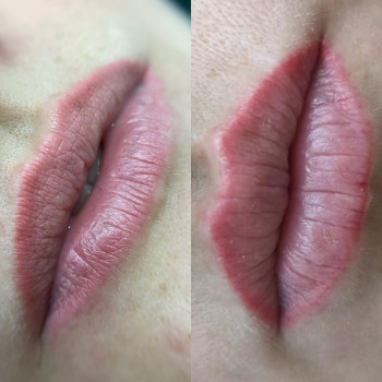 До видалення старого татуажу, на другий день після видалення