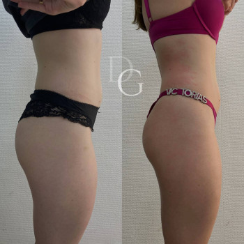 DrumRoll. Ударно-імпульсний вакуумний термомасаж
                    Косметологический центр Dr. Gomon Cosmetology Черкассы