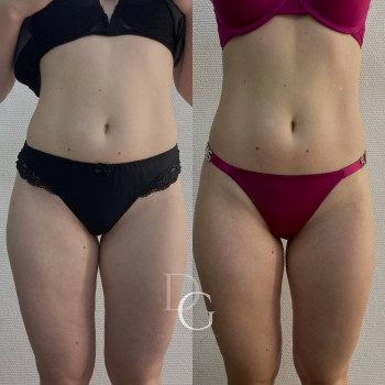 DrumRoll. Ударно-імпульсний вакуумний термомасаж
                    Косметологический центр Dr. Gomon Cosmetology Черкассы