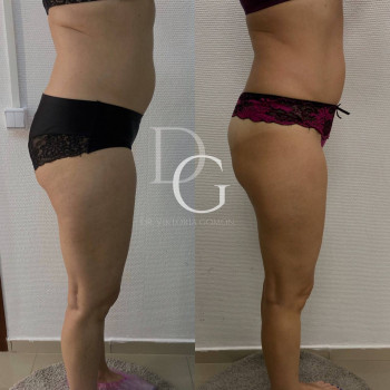 DrumRoll. Ударно-імпульсний вакуумний термомасаж
                    Косметологический центр Dr. Gomon Cosmetology Черкассы