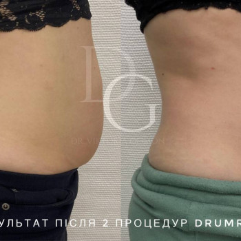 DrumRoll. Ударно-імпульсний вакуумний термомасаж
                    Косметологический центр Dr. Gomon Cosmetology Черкассы