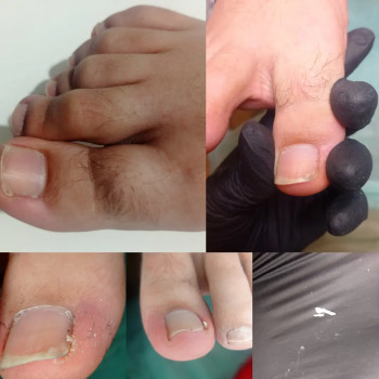 Педикюр - гигиенический, эстетический, подологический
                    Подолог Катерина Ивано-Франковск